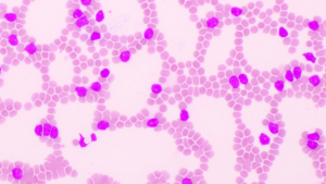 Bild akuter lymphatischer Leukämie-Zellen im Blut, mikroskopische Aufnahme